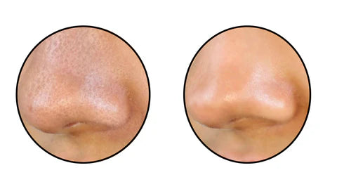 Limpiador de Poros Facial por Succión