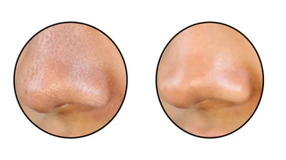 Limpiador de Poros Facial por Succión